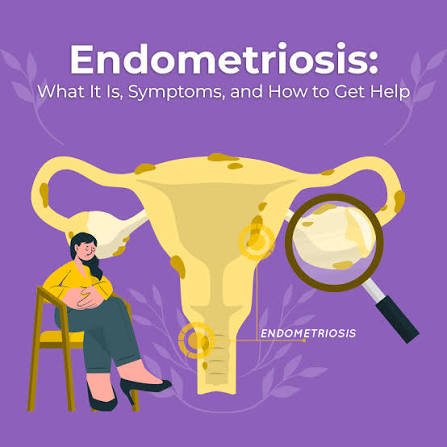 Endometriosis