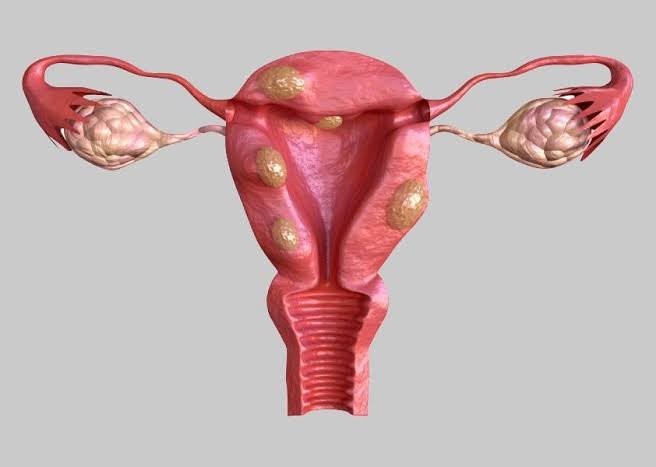Fibroids